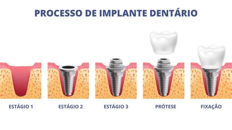 implante dentario|implante dentário protocolo.